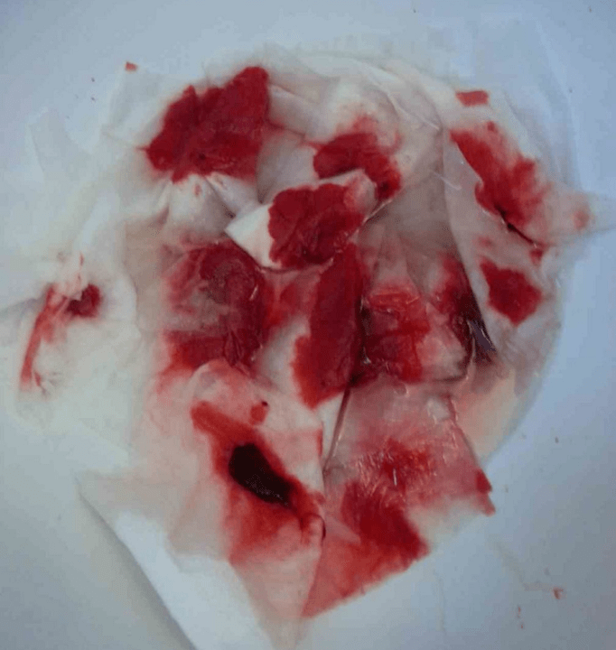 Bloeden met aambeien