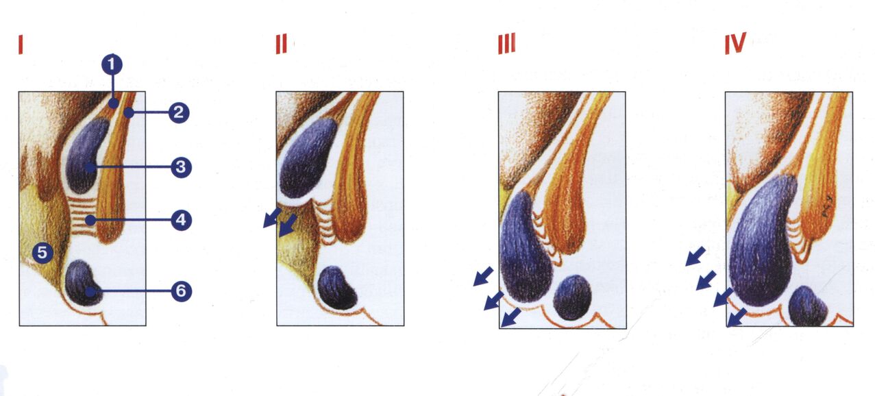 stadia van de ontwikkeling van aambeien